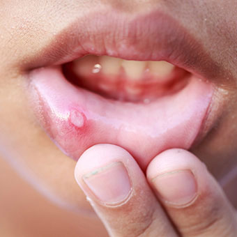 canker sores s2 what are canker sores