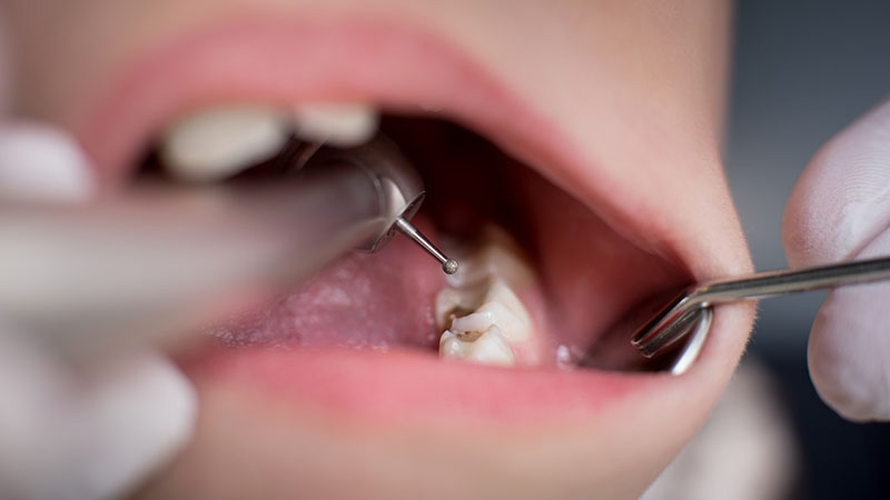 dental fillings las vegas