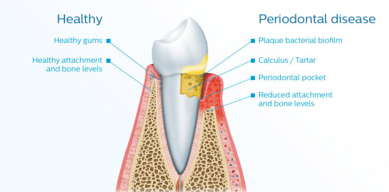 ohc page2 periodontal disease l